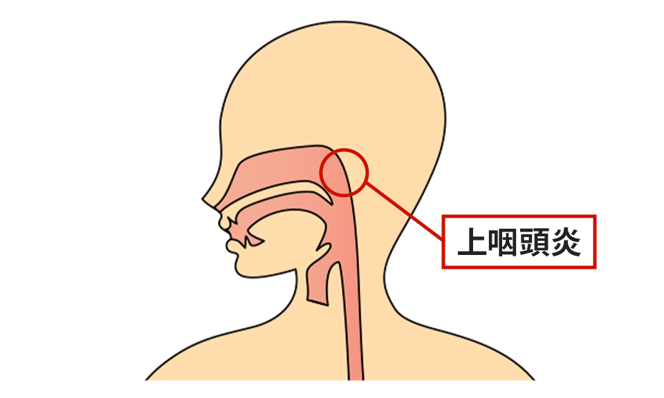 症状の該当箇所のイラスト