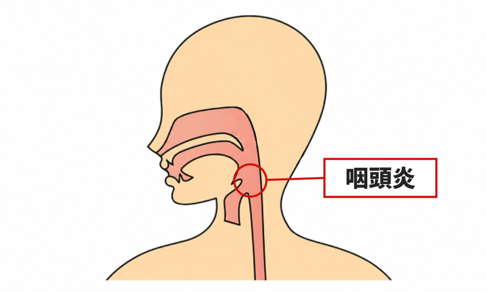 症状の該当箇所のイラスト